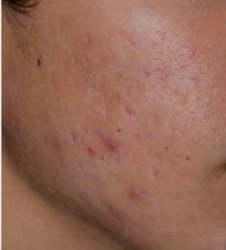 After: Acne scars