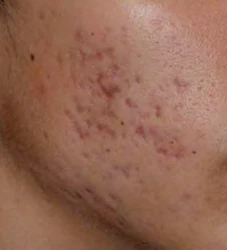 Before: Acne scars