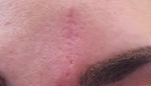 After: Forehead scar