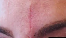 Before: Forehead scar