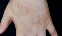 After: Scarring on the hand
