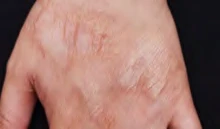 Before: Scarring on the hand