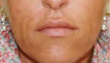 After: Nasolabial lines