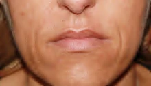 Before: Nasolabial lines