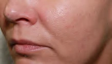 After: Skin texture & pores