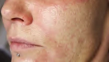 Before: Skin texture & pores