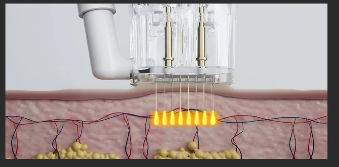 Insulated needles