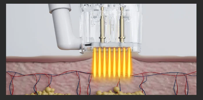 Non-insulated needles