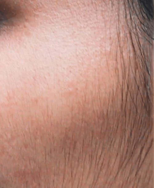 BEFORE IMAGE OF HAIR REMOVAL USING CANDELA GENTLE MAX PRO