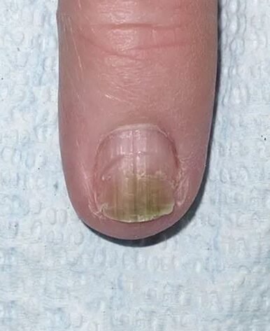 BEFORE IMAGE OF NAIL FUNGUS TREATMENT USING LASER DEVICE