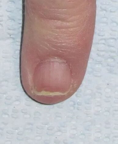 AFTER IMAGE OF NAIL FUNGUS USING TREATMENT USING LASER DEVICE