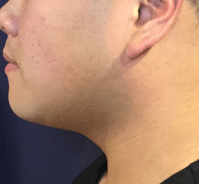 Body Contouring After