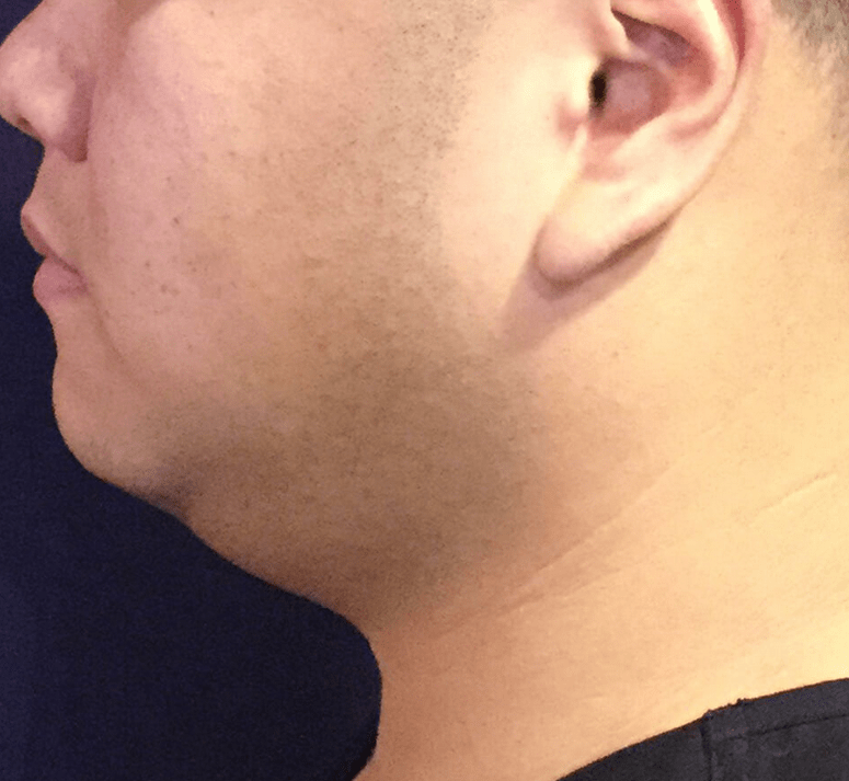 Body Contouring Before