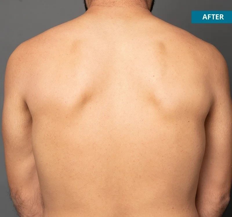 Hair Removal After