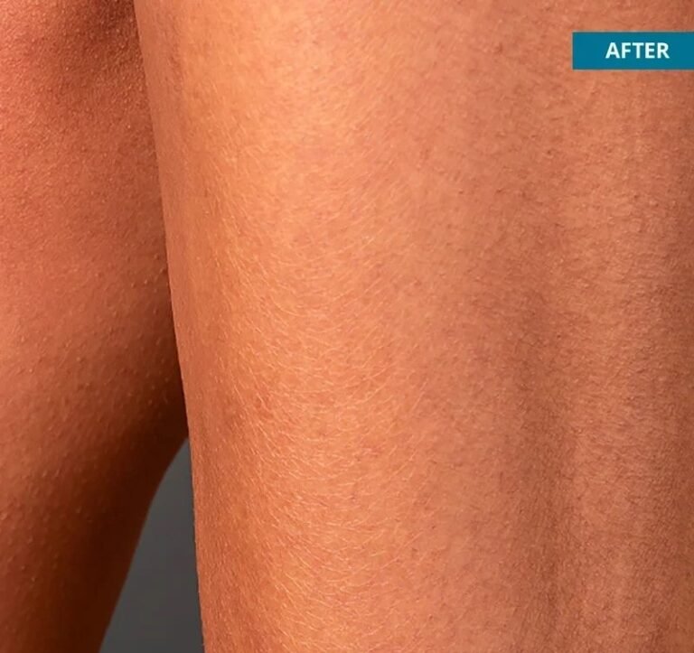 After image of hair removal using Quanta Duetto Mt Evo