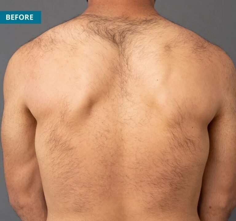 Hair Removal Before image