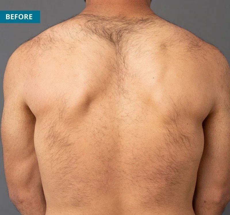 Hair Removal Before