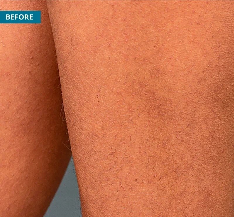 Before image of hair removal using Quanta Duetto Mt Evo