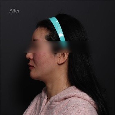 After: Volume restoration with YOUTHFILL
