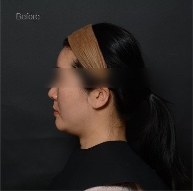Before: Volume restoration with YOUTHFILL