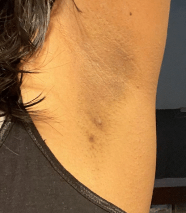 After: Underarm pigmentation with Caresse Lab