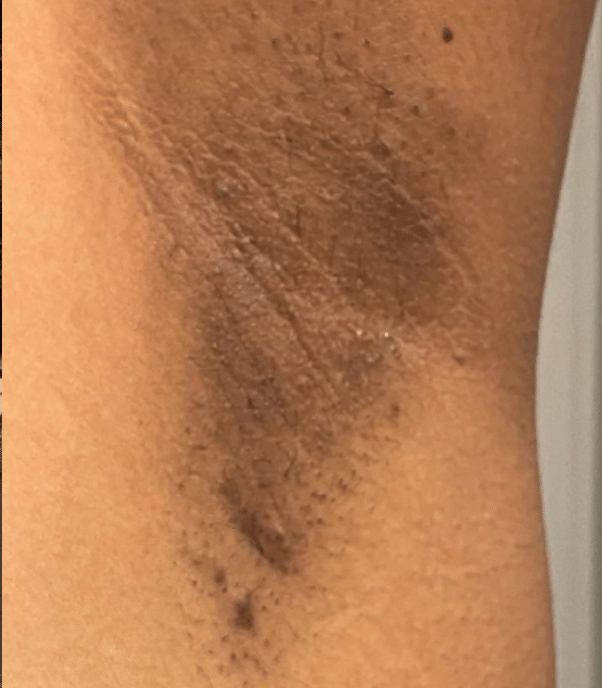 Before: Underarm pigmentation with Caresse Lab